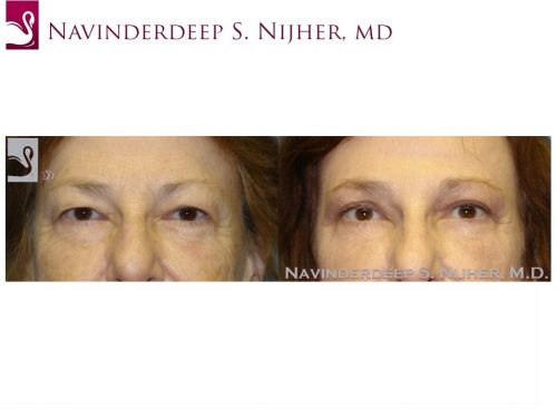 Eyelid Surgery Case #47695 (Image 1)