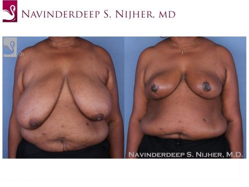 Female Breast Reduction Case #48963 (Image 1)