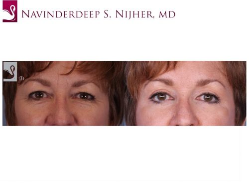 Eyelid Surgery Case #52348 (Image 1)