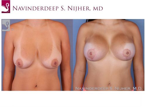 Breast Augmentation with Mastopexy (Breast Lift) Case #53113 (Image 1)