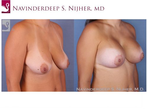 Breast Augmentation with Mastopexy (Breast Lift) Case #53113 (Image 2)