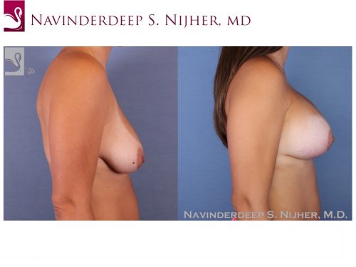 Breast Augmentation with Mastopexy (Breast Lift) Case #53113 (Image 3)
