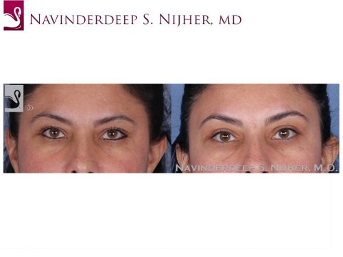 Eyelid Surgery Case #53270 (Image 1)