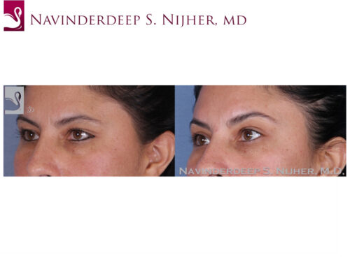 Eyelid Surgery Case #53270 (Image 2)