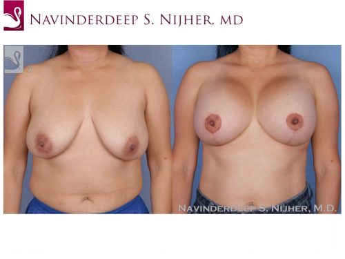 Breast Augmentation with Mastopexy (Breast Lift) Case #53270 (Image 1)