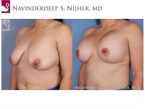 Breast Augmentation with Mastopexy (Breast Lift) Case #53270 (Image 2)