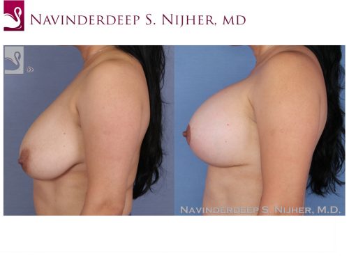 Breast Augmentation with Mastopexy (Breast Lift) Case #53270 (Image 3)