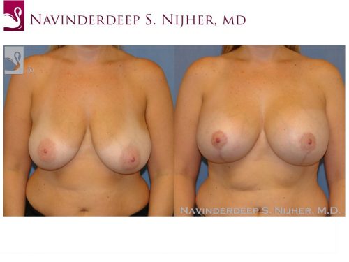 Breast Augmentation with Mastopexy (Breast Lift) Case #43737 (Image 1)