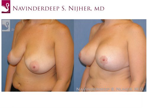 Breast Augmentation with Mastopexy (Breast Lift) Case #43737 (Image 2)