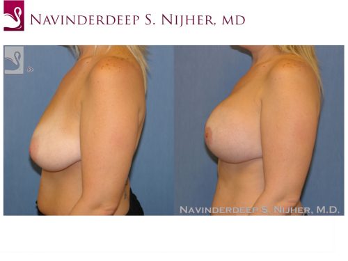 Breast Augmentation with Mastopexy (Breast Lift) Case #43737 (Image 3)