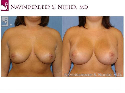 Breast Revisions Case #42185 (Image 1)