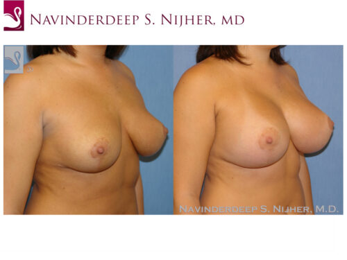 Breast Revisions Case #42185 (Image 2)