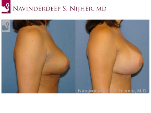 Breast Revisions Case #42185 (Image 3)