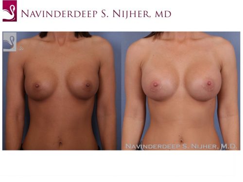 Breast Revisions Case #47576 (Image 1)