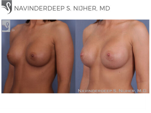 Breast Revisions Case #47576 (Image 2)