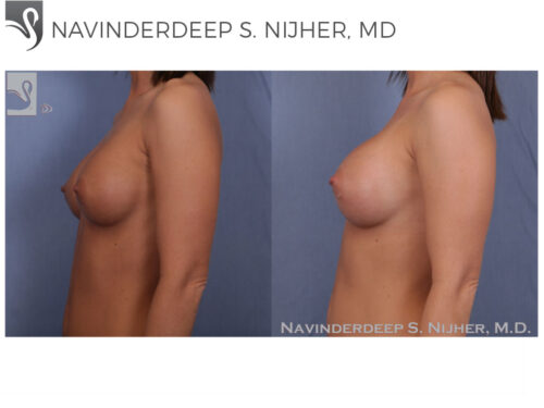 Breast Revisions Case #47576 (Image 3)