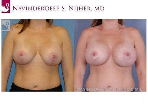 Breast Revisions Case #41358 (Image 1)