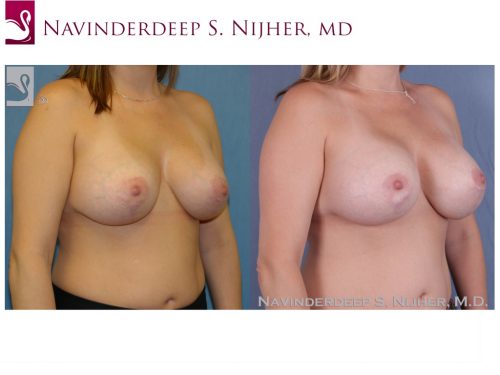 Breast Revisions Case #41358 (Image 2)