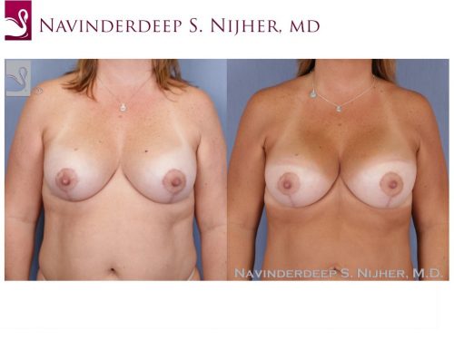Breast Revisions Case #48614 (Image 1)