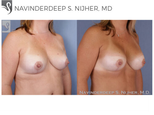 Breast Revisions Case #48614 (Image 2)