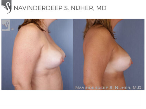 Breast Revisions Case #48614 (Image 3)