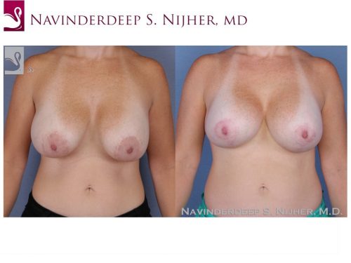 Breast Revisions Case #48643 (Image 1)