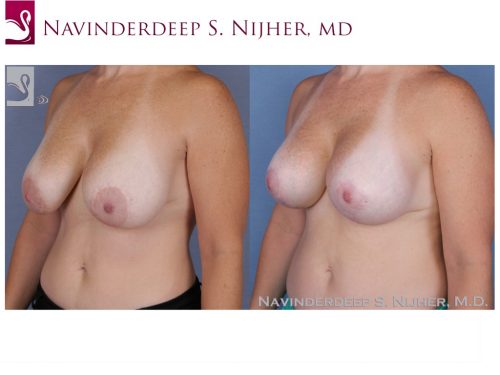 Breast Revisions Case #48643 (Image 2)