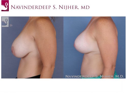 Breast Revisions Case #48643 (Image 3)