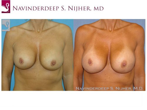 Breast Revisions Case #38931 (Image 1)