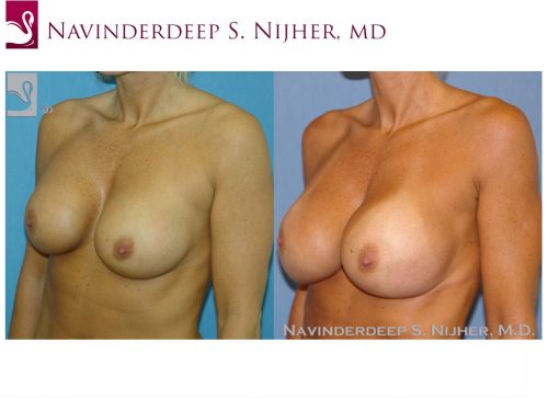 Breast Revisions Case #38931 (Image 2)
