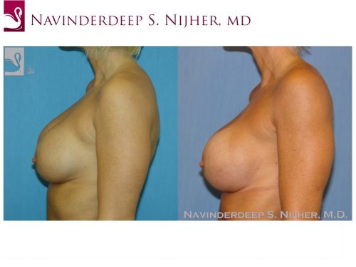 Breast Revisions Case #38931 (Image 3)