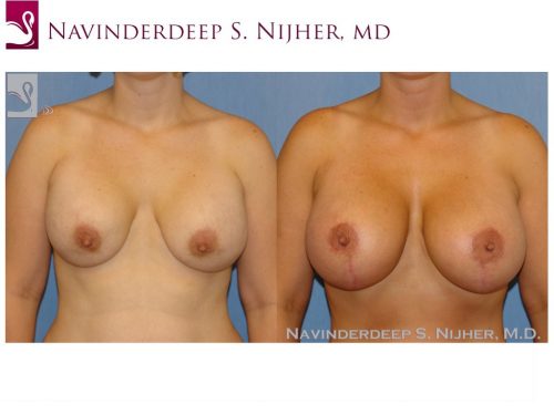 Breast Revisions Case #34573 (Image 1)