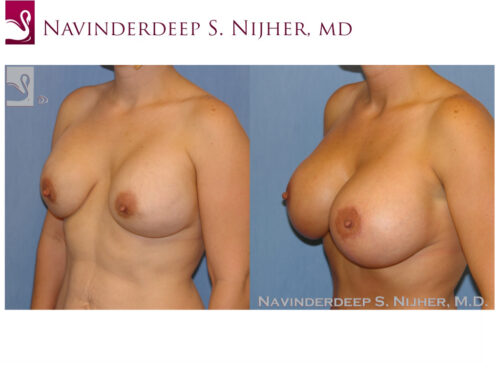 Breast Revisions Case #34573 (Image 2)