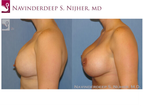 Breast Revisions Case #34573 (Image 3)