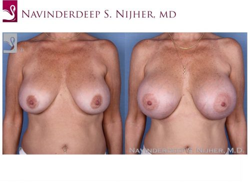 Breast Revisions Case #53841 (Image 1)