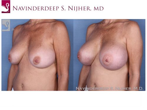 Breast Revisions Case #53841 (Image 2)