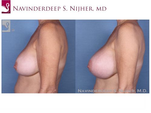 Breast Revisions Case #53841 (Image 3)