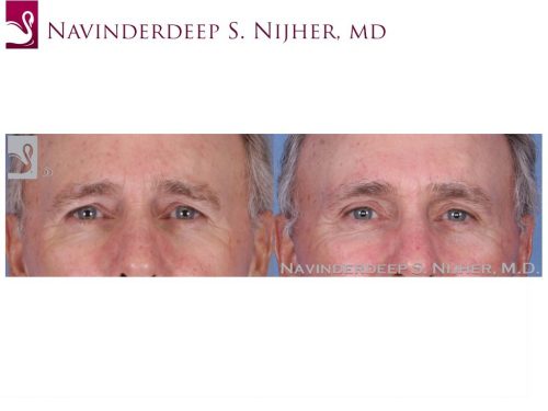Eyelid Surgery Case #51540 (Image 1)