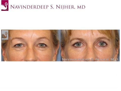 Eyelid Surgery Case #48769 (Image 1)