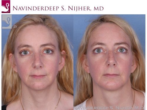 Facial Implants Case #54883 (Image 1)