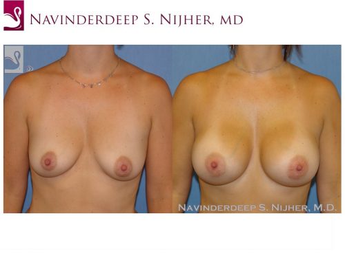 Breast Augmentation Case #43336 (Image 1)