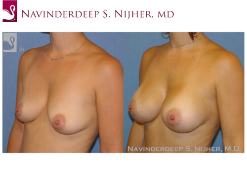 Breast Augmentation Case #43336 (Image 2)
