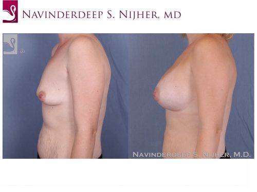 Breast Augmentation Case #50357 (Image 3)