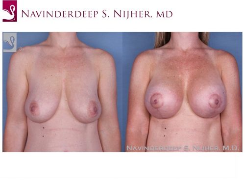 Breast Augmentation with Mastopexy (Breast Lift) Case #37143 (Image 1)