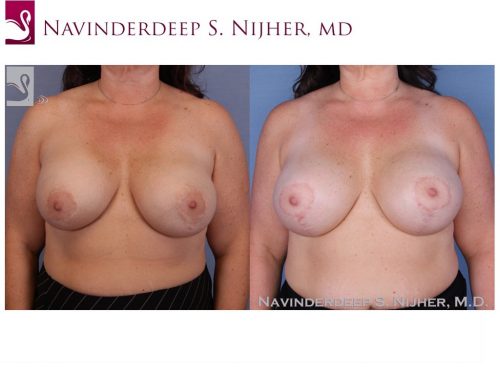 Breast Revisions Case #48262 (Image 1)