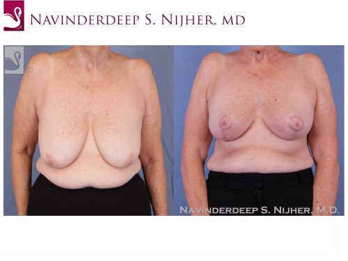 Female Breast Reduction Case #51961 (Image 1)