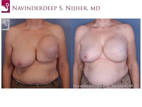 Breast Reconstruction Case #47453 (Image 1)