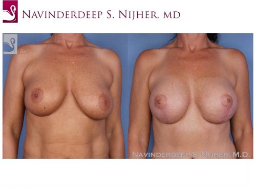Breast Augmentation with Mastopexy (Breast Lift) Case #20729 (Image 1)