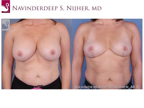Breast Revisions Case #52739 (Image 1)