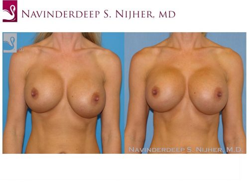Breast Revisions Case #45044 (Image 1)
